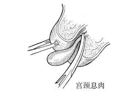 宫颈有了息肉会出现什么症状